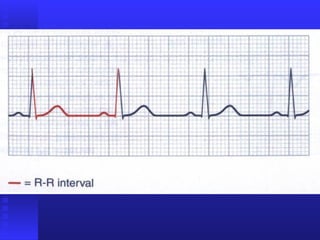  ekg-lengkap-ppt
