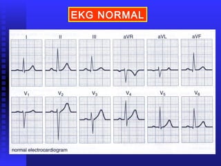 EKG NORMAL
 