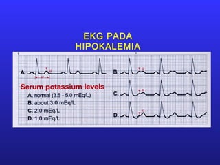 EKG PADA
HIPOKALEMIA
 