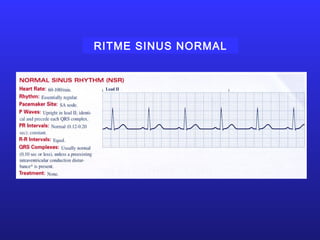 RITME SINUS NORMAL
 
