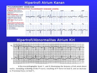 Hipertrofi Atrium Kanan
Hipertrofi/Abnormalitas Atrium Kiri
 