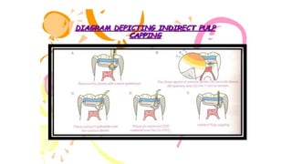 pulp therapy of primary teeth | PDF