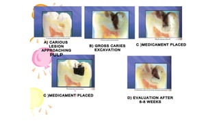pulp therapy of primary teeth | PDF