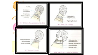 pulp therapy of primary teeth | PDF