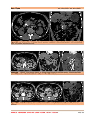 Case Report ISSN (O):2395-2822; ISSN (P):2395-2814
Annals of International Medical and Dental Research, Vol (1), Issue (3) Page 345
Figure 1 & 2: Axial and coronal plain CT revealed relatively hyperdense rounded mass with central oval hypodensity in the pancreatic head
region associated with partial rim calcification.
Figure 3, 4 & 5: Transverse, coronal and MIP images of the abdomen showed an enhancing aneurysmal mass with well-demarcated borders
surrounded by thrombus with extensive calcification on the outer surface of the aneurysm.
Figure 6, 7 & 8: Axial and coronal images of abdomen show aneurysmal mass causing direct pressure over the head of the pancreas and
duodenum.
 