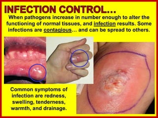 When pathogens increase in number enough to alter the
functioning of normal tissues, and infection results. Some
infections are contagious… and can be spread to others.
Common symptoms of
infection are redness,
swelling, tenderness,
warmth, and drainage.
 