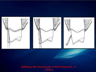 Shillinburg HT. Fundamentals of Tooth Preparation. 3rd
Edition.
 