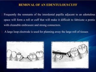 REMOVAL OF AN EDENTULOUSCUFF
Frequently the remnants of the interdental papilla adjacent to an edentulous
space will form a roll or cuff that will make it difficult to fabricate a pontic
with cleanable embrasure and strong connectors.
A large loop electrode is used for planning away the large roll of tissues.
 