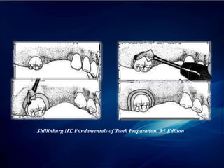 Shillinburg HT. Fundamentals of Tooth Preparation. 3rd Edition
 