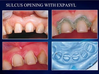 SULCUS OPENING WITH EXPASYL
 