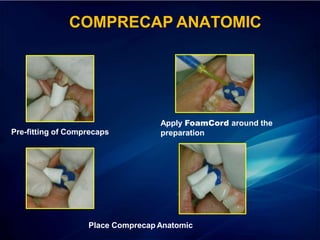 Pre-fitting of Comprecaps
Apply FoamCord around the
preparation
COMPRECAP ANATOMIC
Place Comprecap Anatomic
 