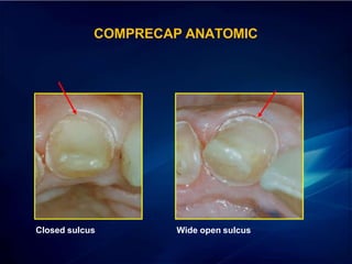 Closed sulcus Wide open sulcus
COMPRECAP ANATOMIC
 