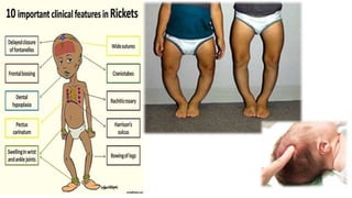 Osteomalacia & Rickets | PPTX