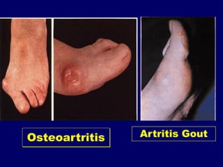 Rematism 168826173-Penanganan-Artritis-Dan-Reumatism-Slide-Komplet.pdf