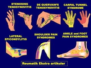 Rematism 168826173-Penanganan-Artritis-Dan-Reumatism-Slide-Komplet.pdf