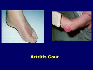 Rematism 168826173-Penanganan-Artritis-Dan-Reumatism-Slide-Komplet.pdf