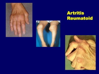 Rematism 168826173-Penanganan-Artritis-Dan-Reumatism-Slide-Komplet.pdf