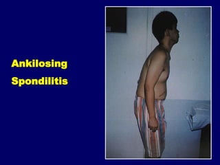 Rematism 168826173-Penanganan-Artritis-Dan-Reumatism-Slide-Komplet.pdf