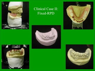Clinical Case II:
Fixed-RPD
 