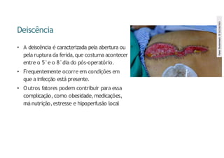 Deiscência
• A deiscência é caracterizada pela abertura ou
pela ruptura da ferida,que costuma acontecer
entre o 5 ̊ e o 8 ̊ dia do pós-operatório.
• Frequentemente ocorre em condições em
que a infecção está presente.
• Outros fatores podem contribuir para essa
complicação, como obesidade, medicações,
má nutrição,estresse e hipoperfusão local
Fonte:
Shutterstock.
ID
1623367003
 
