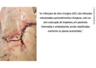 "As infecções de sítio cirúrgico (ISC) são infecções
relacionadas aprocedimentos cirúrgicos, com ou
sem colocação de implantes,em pacientes
internados e ambulatoriais,sendo classificados
conforme os planos acometidos."
Fonte:
Shutterstock.
ID
1600725589
 