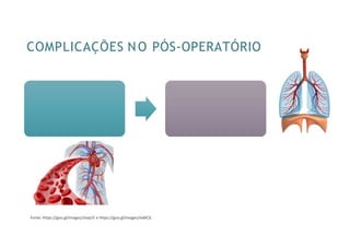 COMPLICAÇÕES NO PÓS-OPERATÓRIO
Complicações
respiratórias
Complicações
cardiovasculares
Fonte: https://goo.gl/images/JJoqU5 e https://goo.gl/images/ex8iCX.
 