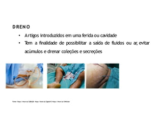 Fonte: https://shutr.bz/3j8loQN https://shutr.bz/3gdub1O https://shutr.bz/34kAUoe
D REN O
• Artigos introduzidos em uma ferida ou cavidade
• T
em a finalidade de possibilitar a saída de fluidos ou ar
, evitar
acúmulos e drenar coleções e secreções
 