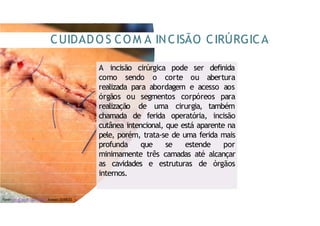 A incisão cirúrgica pode ser definida
como sendo o corte ou abertura
realizada para abordagem e acesso aos
órgãos ou segmentos corpóreos para
realização de uma cirurgia, também
chamada de ferida operatória, incisão
cutânea intencional, que está aparente na
pele, porém, trata-se de uma ferida mais
profunda que se estende por
minimamente três camadas até alcançar
as cavidades e estruturas de órgãos
internos.
CUIDADO S COM A INCISÃO CIRÚRGICA
Fonte:https:/
/
shutr.bz/
31j6VLO Acesso:20/
08/
22
 