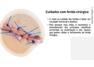 Cuidados com ferida cirúrgica
• A meta no cuidado das feridas é obter um
resultado funcional e estético.
• Para alcançar essa meta, é necessário o
entendimento dos princípios científicos
envolvidos na cicatrização e dos fatores
que podem afetar o fechamento da ferida
cirúrgica.
Fonte:
Shutterstock.
ID
187687526
 