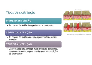 Tipos de cicatrização
PRIMEIRA INTENÇÃO
• As bordas da ferida são apostas ou aproximadas.
SEGUNDA INTENÇÃO
• As bordas da ferida não estão aproximadas e existe
infecção
TERCEIRA INTENÇÃO
• Ocorre após uma limpeza mais profunda, deiscência,
ressutura ou enxerto para restabelecer as condições
de cicatrização.
Fonte: https://goo.gl/images/nX7QjT. Acesso em 22/08/22
 