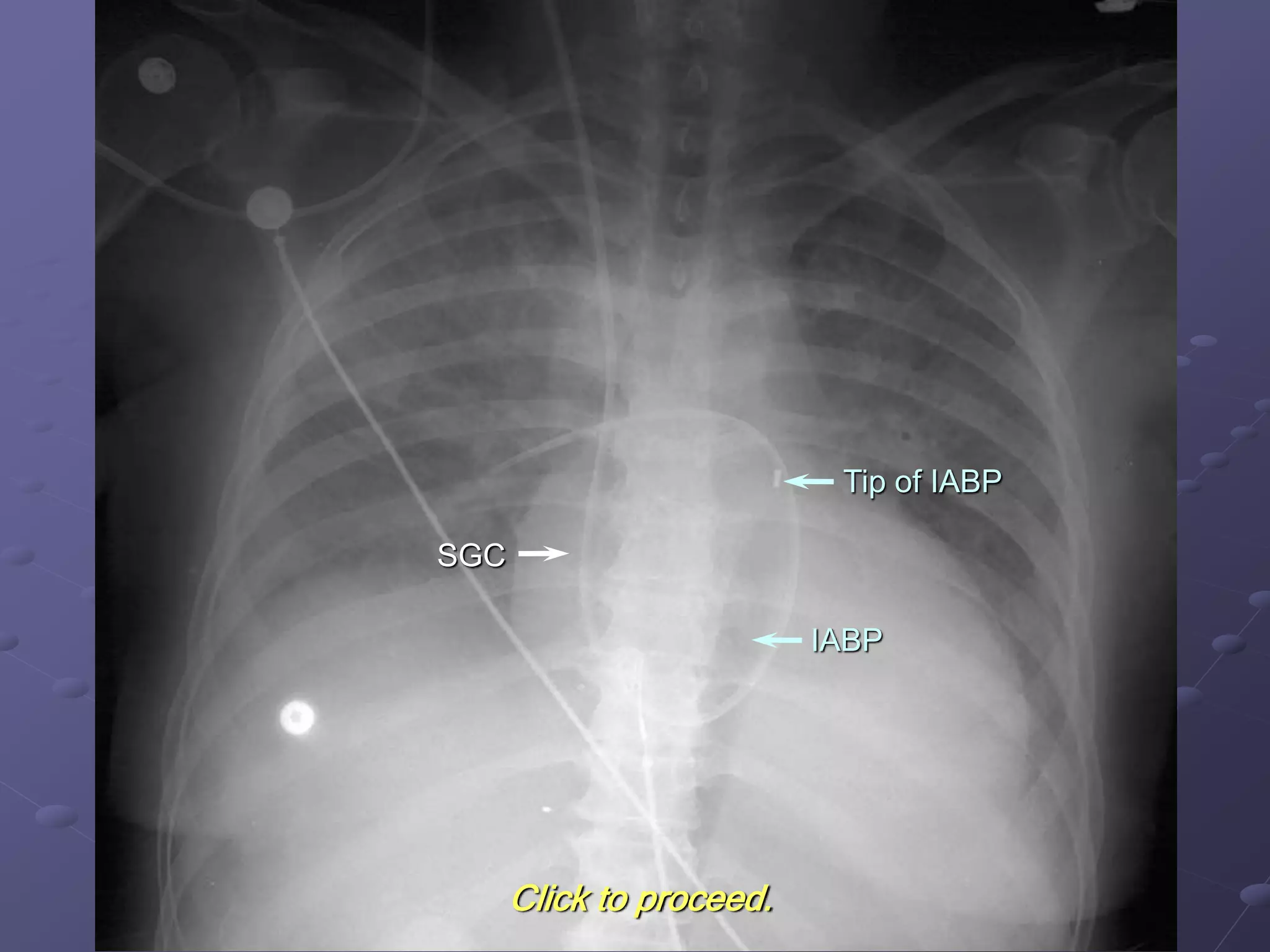 SGC
Tip of IABP
IABP
Click to proceed.
 