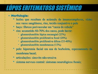 LÚPUS ERITEMATOSO SISTÊMICO
• Morfologia:

 lesões que resultam de acúmulo de imunocomplexos, vistas
nos vasos sangüíneos, rins, tecido conjuntivo e pele
 baço: fibrose perivascular em “casca de cebola”
 rim: acometido 60-70% dos casos, pode haver:
•
•
•
•

glomerulonefrite lúpica mesangial (25%)
glomerulonefrite proliferativa focal (20%)
glomerulonefrite proliferativa difusa (35-40%)
glomerulonefrite membranosa (15%)

 pele: hiperemia facial em asa de borboleta, espessamento da
membrana basal;
 articulações: sinovite não-erosiva
 sistema nervoso central: sintomas neurológicos focais;

 