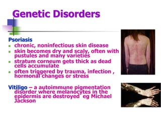 Genetic Disorders
Psoriasis
 chronic, noninfectious skin disease
 skin becomes dry and scaly, often with
pustules and many varieties
 stratum corneum gets thick as dead
cells accumulate
 often triggered by trauma, infection ,
hormonal changes or stress
Vitiligo – a autoimmune pigmentation
disorder where melanocytes in the
epidermis are destroyed eg Michael
Jackson
 