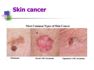 Skin cancer
 
