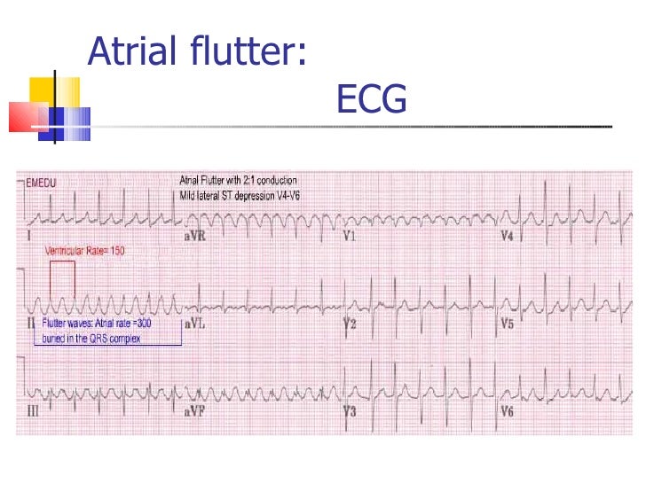 atrial flutter vs svt