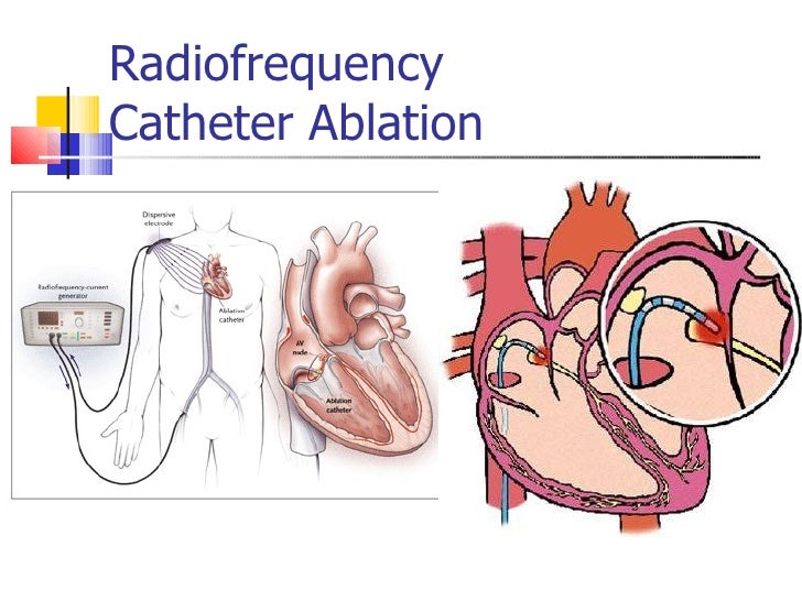 Что такое прижигание при аритмии. Высокочастотная абляция сердца. Что такое прижигание при аритмии. Что такое прижигание при аритмии. Радиочастотная катетерная абляция.