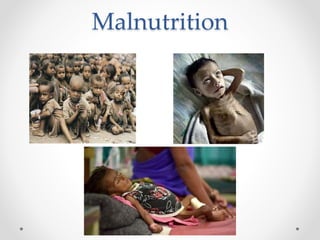 Malnutrition
 