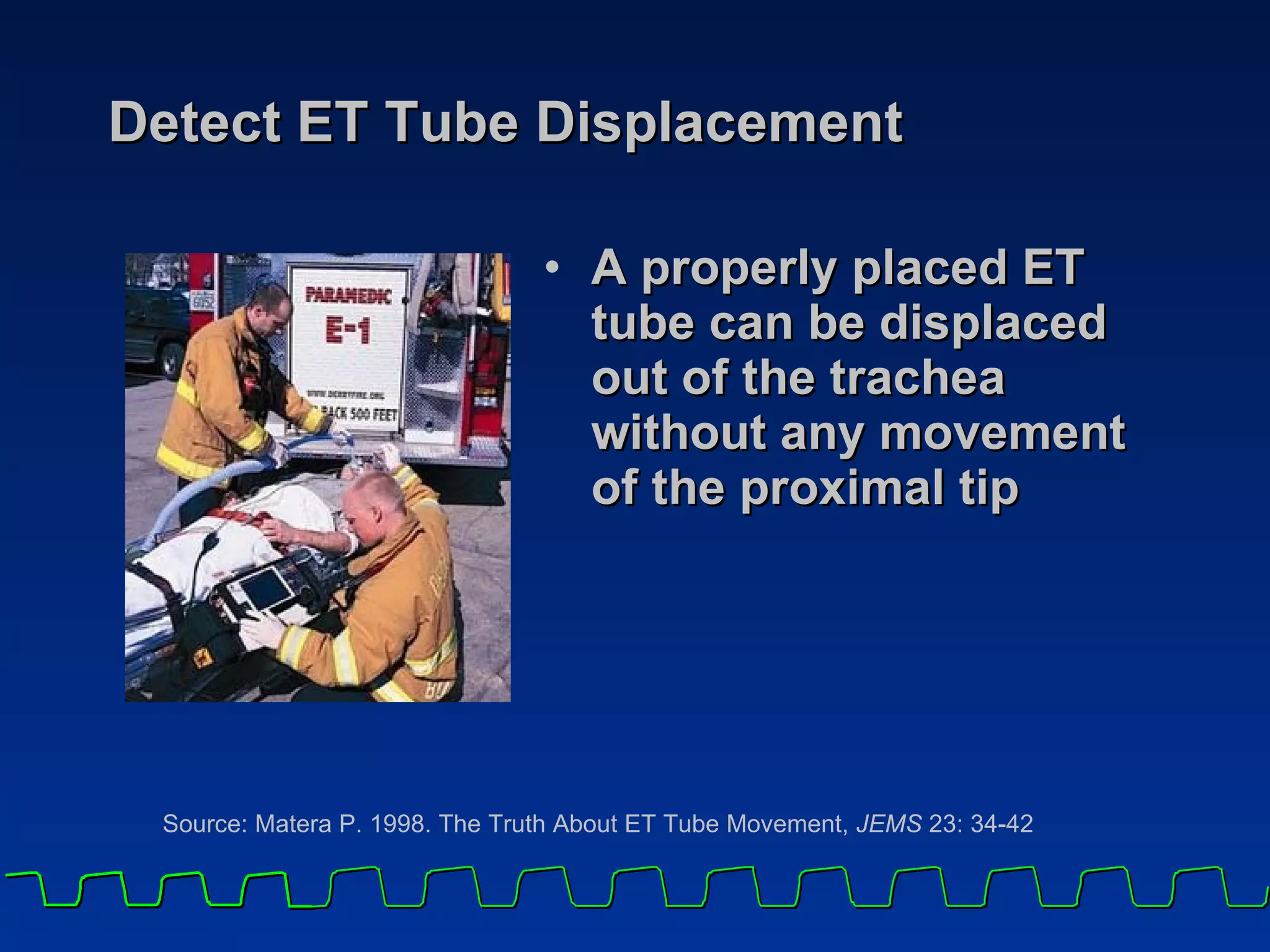 Detect ET Tube Displacement A properly placed ET tube can be displaced out of the trachea without any movement of the proximal tip Source: Matera P. 1998. The Truth About ET Tube Movement,  JEMS  23: 34-42 