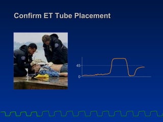 Confirm ET Tube Placement 4 5 0 