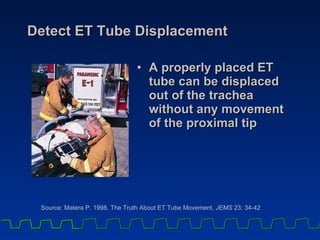 Detect ET Tube Displacement A properly placed ET tube can be displaced out of the trachea without any movement of the proximal tip Source: Matera P. 1998. The Truth About ET Tube Movement,  JEMS  23: 34-42 