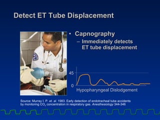 Detect ET Tube Displacement Capnography Immediately detects  ET tube displacement Source: Murray I. P.  et. al . 1983. Early detection of endotracheal tube accidents by monitoring CO 2  concentration in respiratory gas.  Anesthesiology  344-346  4 5 0 Hypopharyngeal Dislodgement 