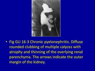 Chronic Pyelonephritis Blunted Calyx