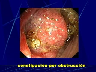 constipación por obstrucción   