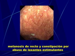 melanosis de recto y constipación por abuso de laxantes estimulantes   