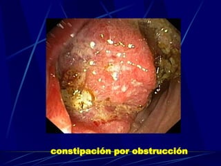 constipación por obstrucción   