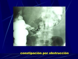 constipación por obstrucción   