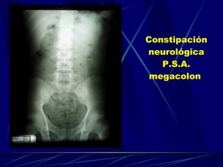 Constipación neurológica P.S.A. megacolon   