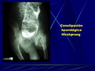 Constipación neurológica Hirshprung   