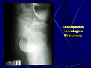 Constipación neurológica Hirshprung   