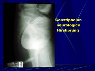 Constipación neurológica Hirshprung   